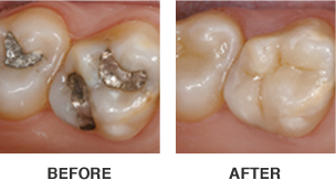 CEREC-before-after-image-304x163 CEREC-before-after-image-304x163